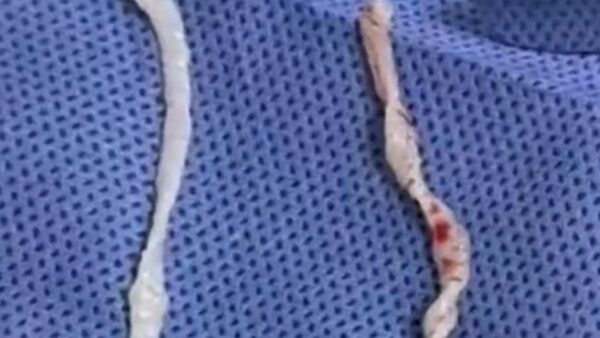 Đau cánh tay suốt một năm, người phụ nữ bàng hoàng khi bác sĩ phát hiện hai sinh vật dài 10cm đang sống dưới da