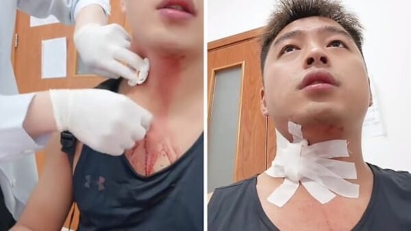 Người đàn ông suýt “gặp họa” vì một cú đập muỗi làm vỡ mạch máu ở cổ